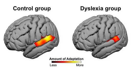 Brains Of People With Dyslexia Don’t Adapt To New Stuff